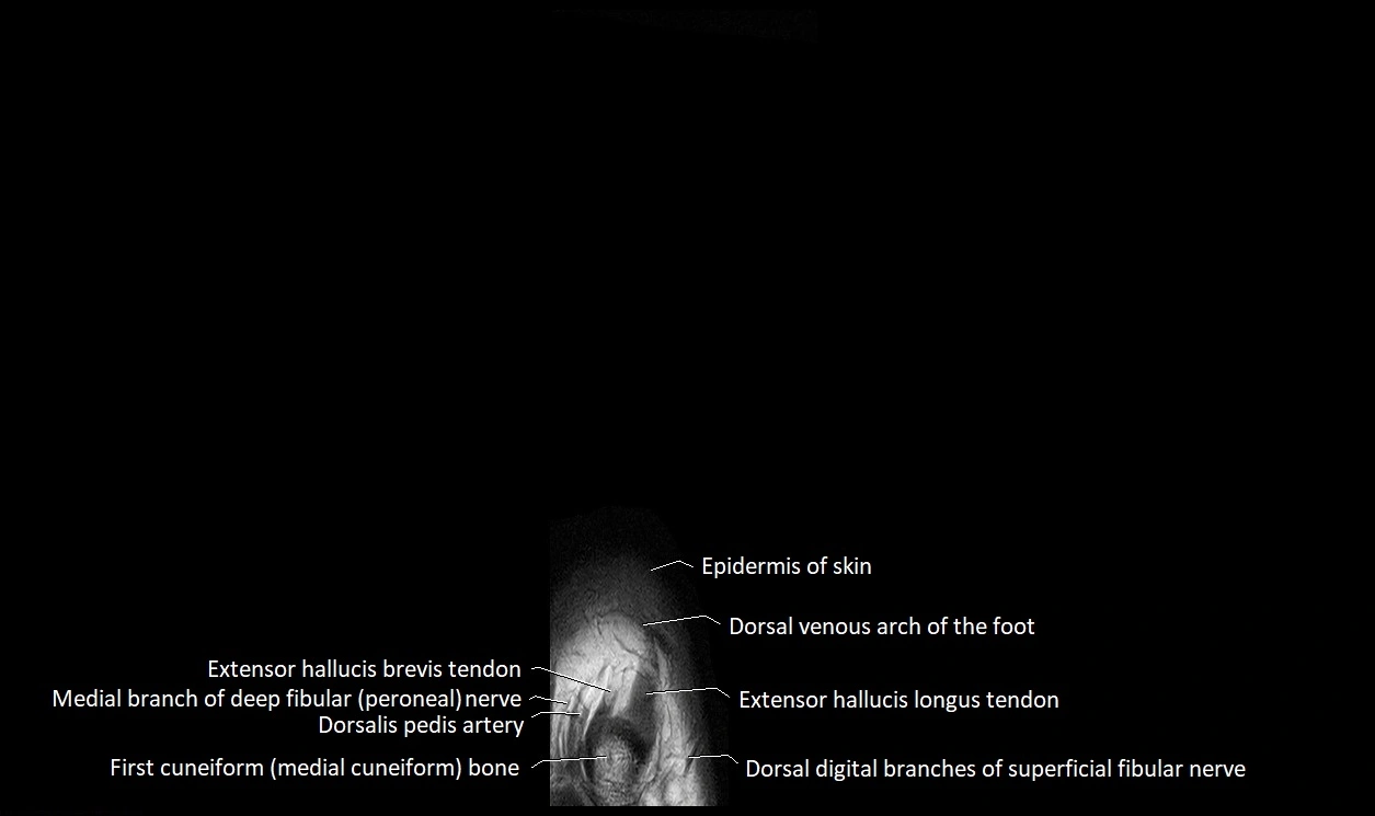 Great Toe micro anatomy MRI axial cross sectional 3T image 3.webp